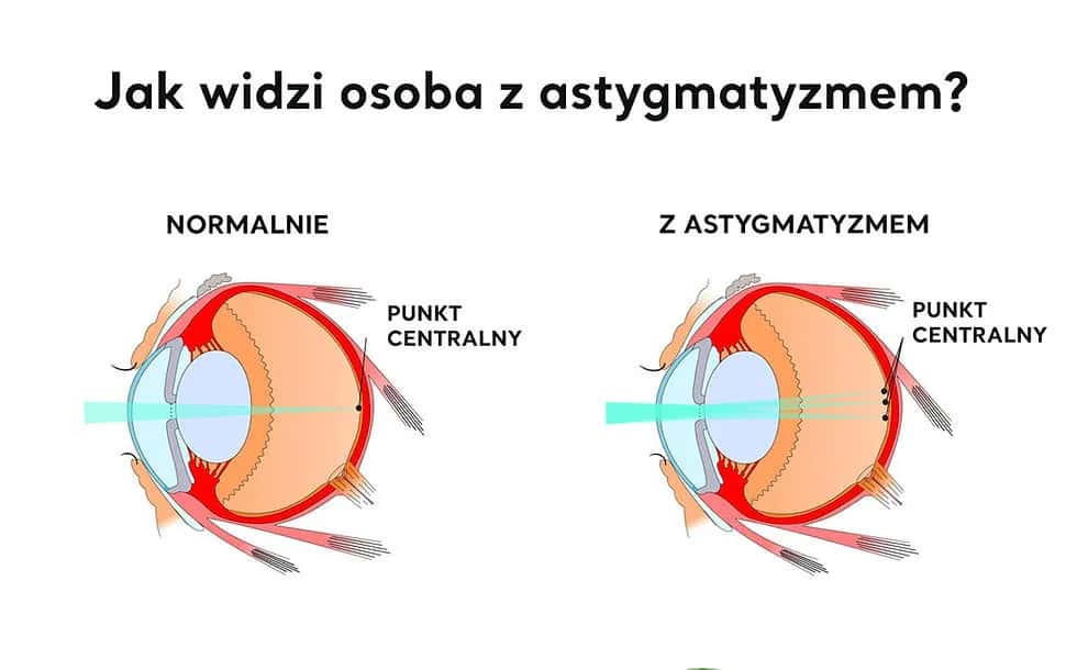 Jakie są wady wzroku? Poznaj objawy i skuteczne leczenie