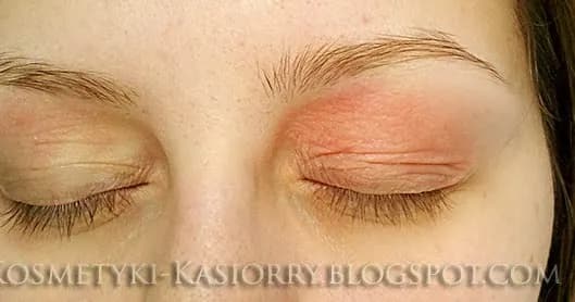 Alergia na oprawki okularowe: objawy, przyczyny i jak sobie radzić